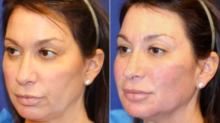 vampire facelift