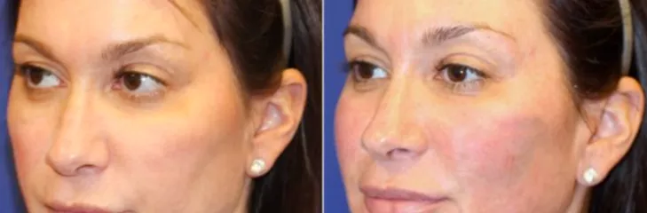 vampire facelift
