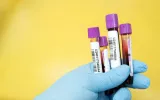 Ferritin Test in Delhi