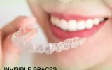 Invisible braces specialist in bangalore 