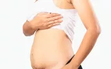 Tummy tuck after pregnancy
