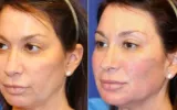 vampire facelift